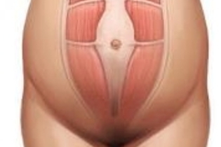 abdominoplastia e gestação 1