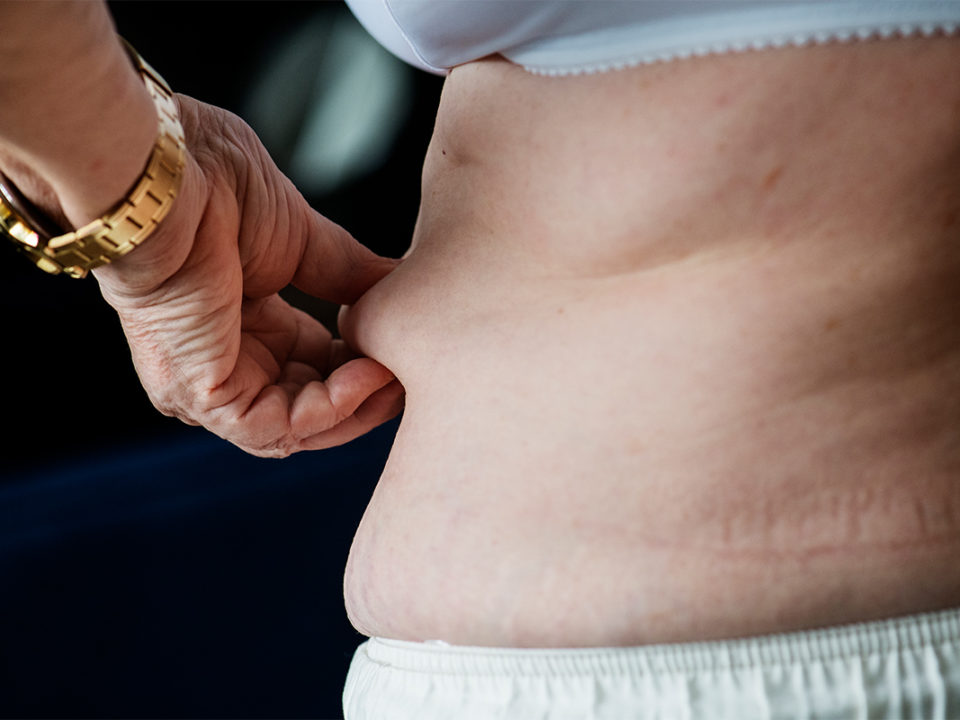 Abdominoplastia O Tratamento para o abdômen